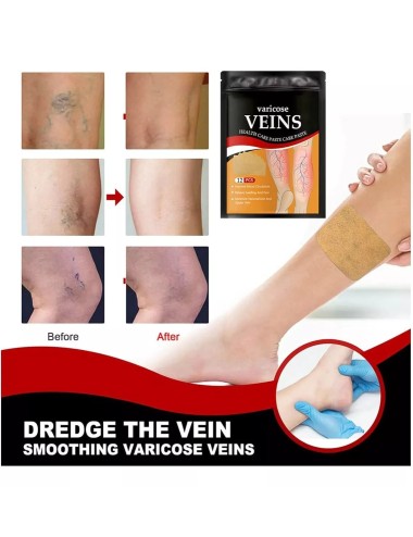 Parches Para Varices, Alivia Dolor E Inflamación 12pz