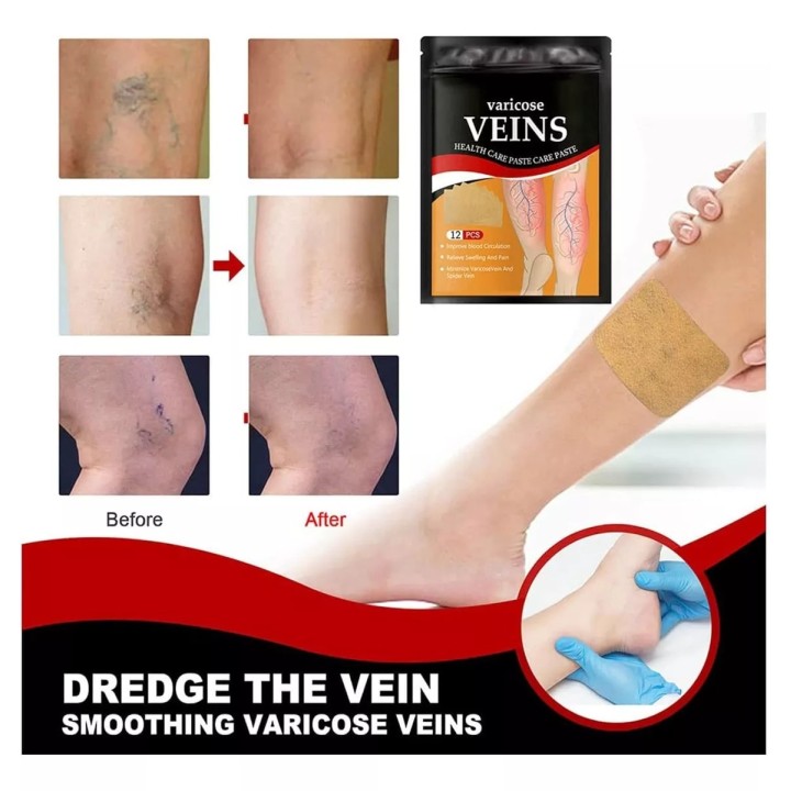 Parches Para Varices, Alivia Dolor E Inflamación 12pz
