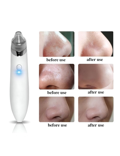 Eliminador Extractor Puntos Y Espinillas Facial Recargable